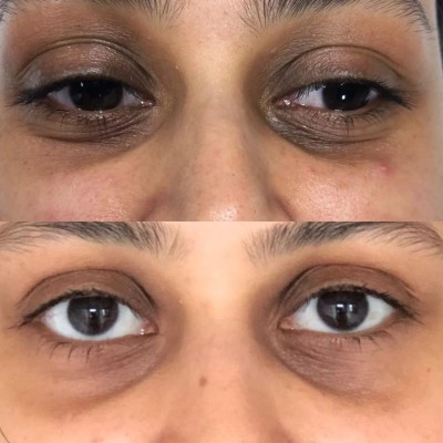 INNO 02 MELINE® DARK CIRCLES Крем против тъмни кръгове под очите 10ml