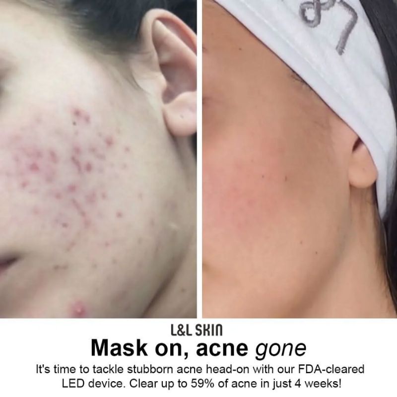 L & L Skin - LUMI LED Light Therapy Skincare Mask LED маска за светлинна терапия