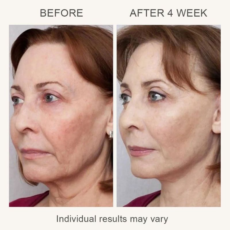 L & L Skin VIA 3-in-1 Skin Rejuvenation Device - Устройство за стягане и подмладяване на кожата 3 в 1