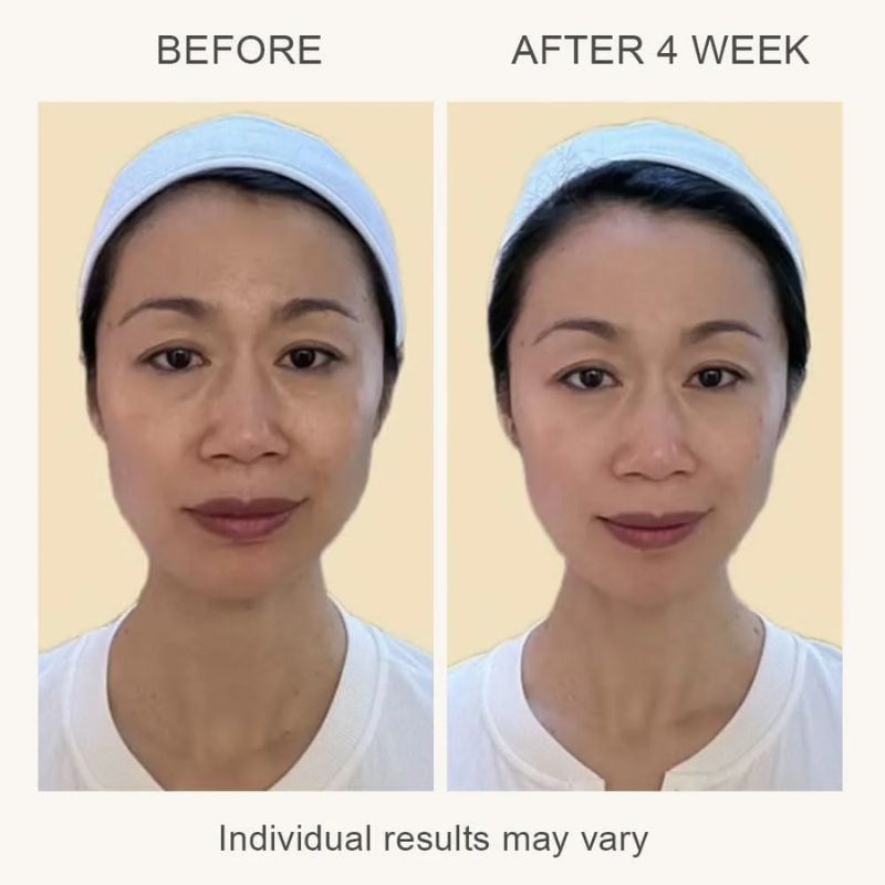 L & L Skin VIA 3-in-1 Skin Rejuvenation Device - Устройство за стягане и подмладяване на кожата 3 в 1