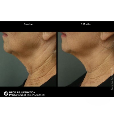 Marini SkinSolutions - Juveneck neck and décolleté cream Крем за шия и деколте против бръчки 50 ml