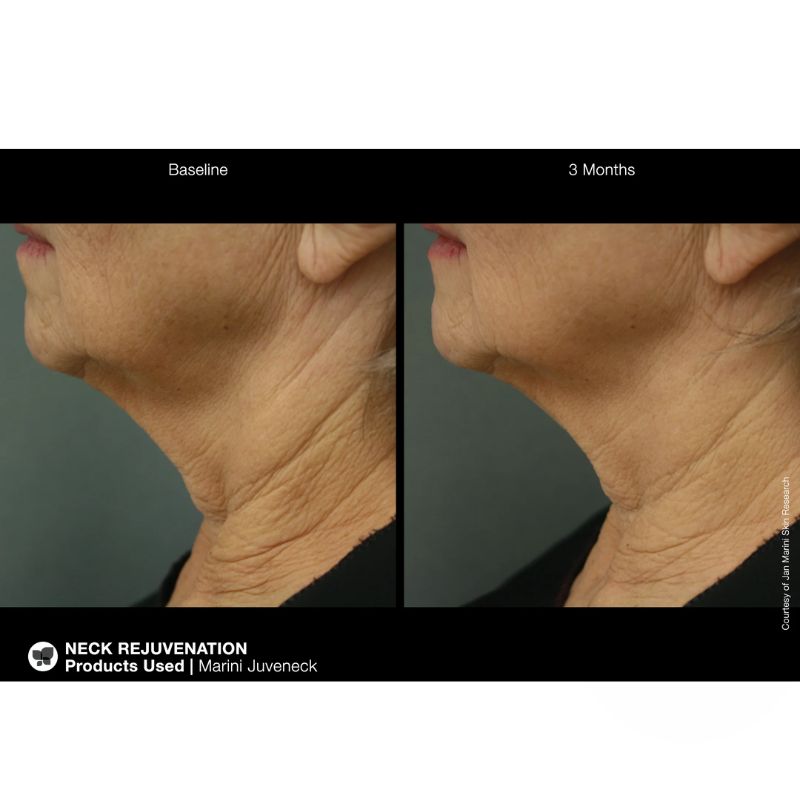Marini SkinSolutions - Juveneck neck and décolleté cream Крем за шия и деколте против бръчки 50 ml
